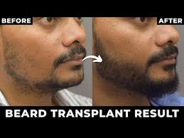 Beard Transplantation