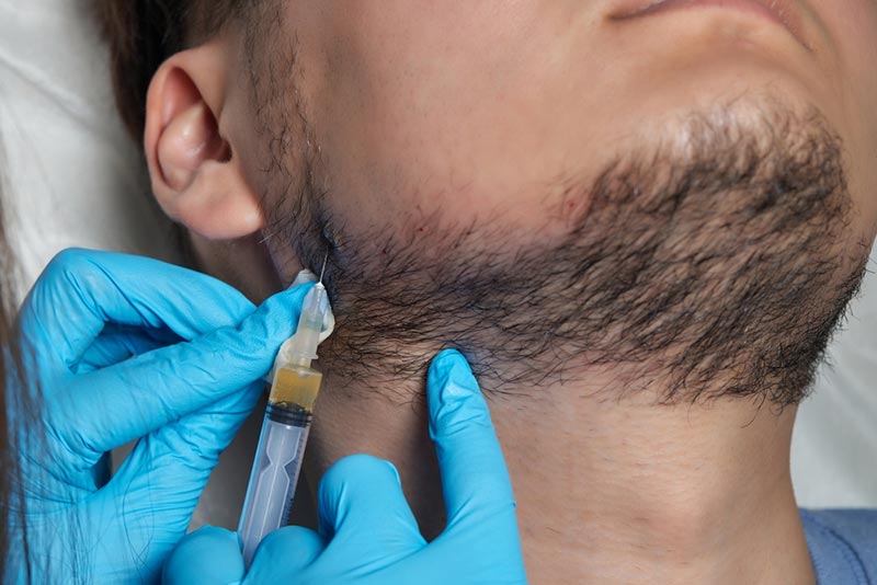 Beard Transplant Results